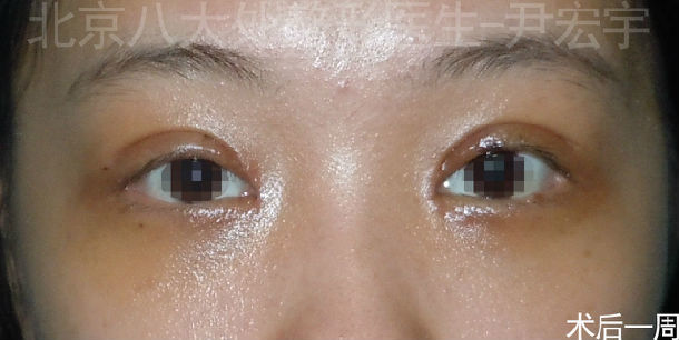 重睑 内眦开大 下睑睑袋切除术(经结膜入路) - 好大夫在线