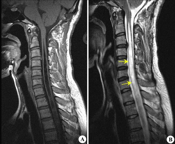 脊髓空洞 - 好大夫在线