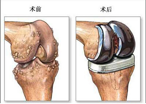 骨关节炎