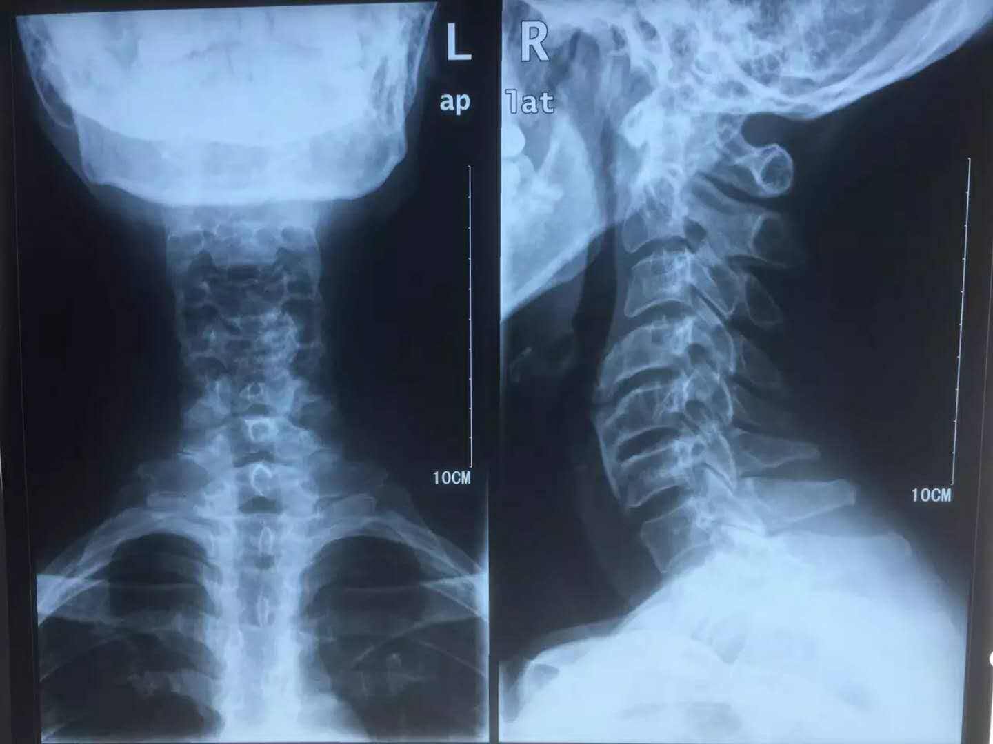 颈椎横突前后结节图片图片