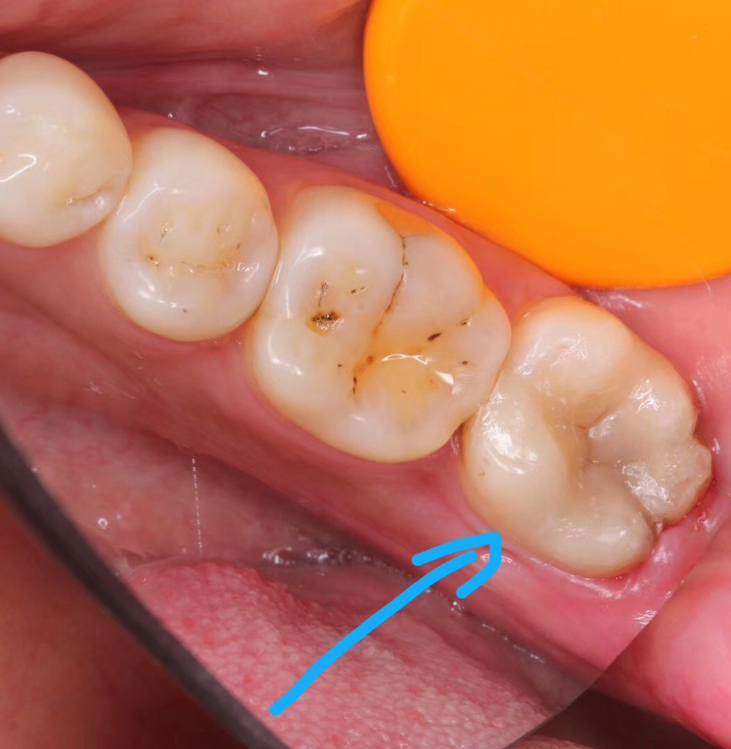 你以前补的牙还好吗! - 好大夫在线