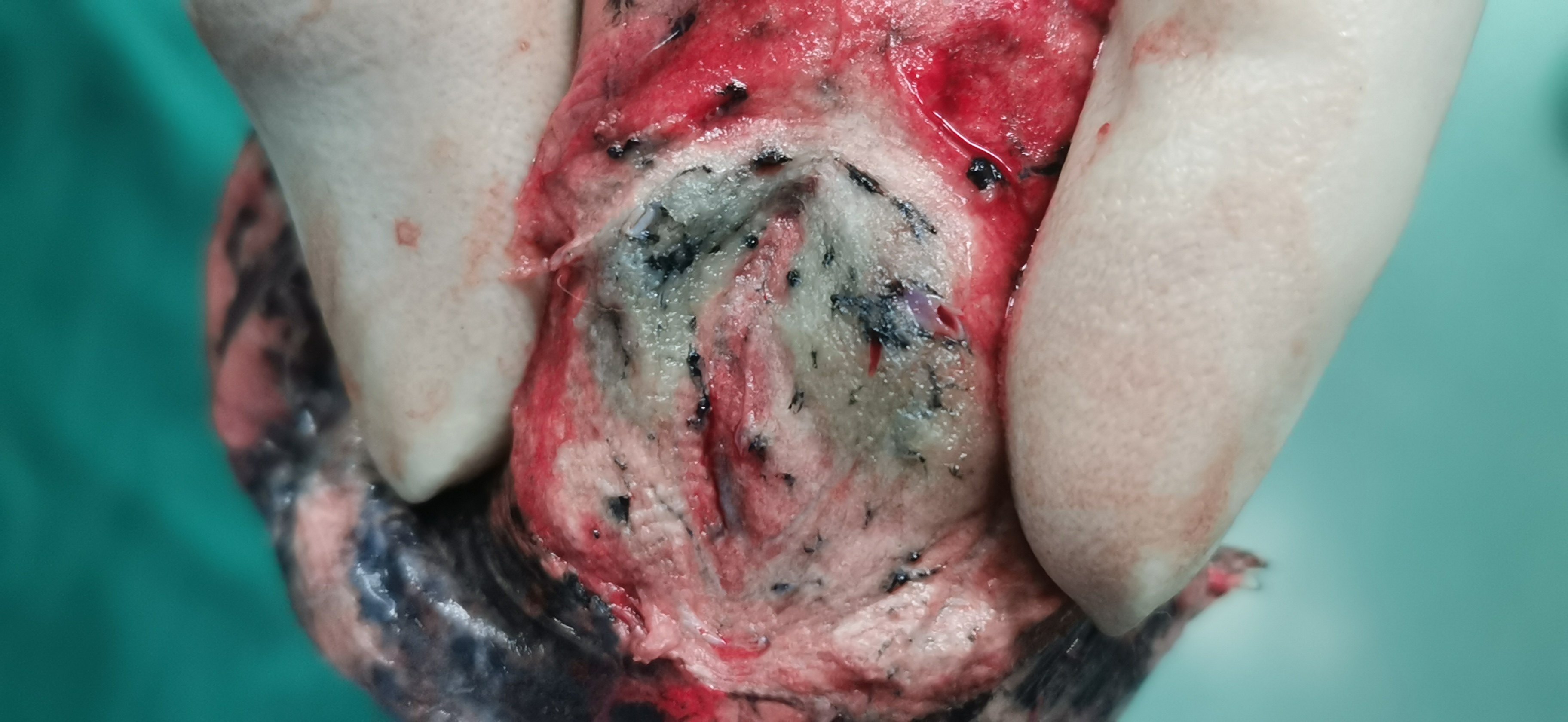 左上肺磨玻璃结节,8毫米,腺癌 - 好大夫在线