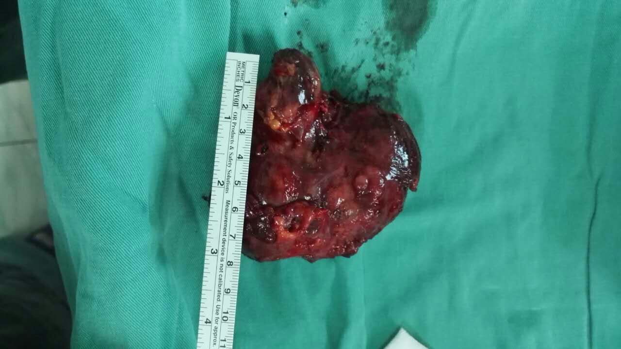 左腮腺肿物 - 好大夫在线