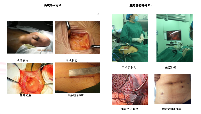 腹部手术缝合几层图解图片