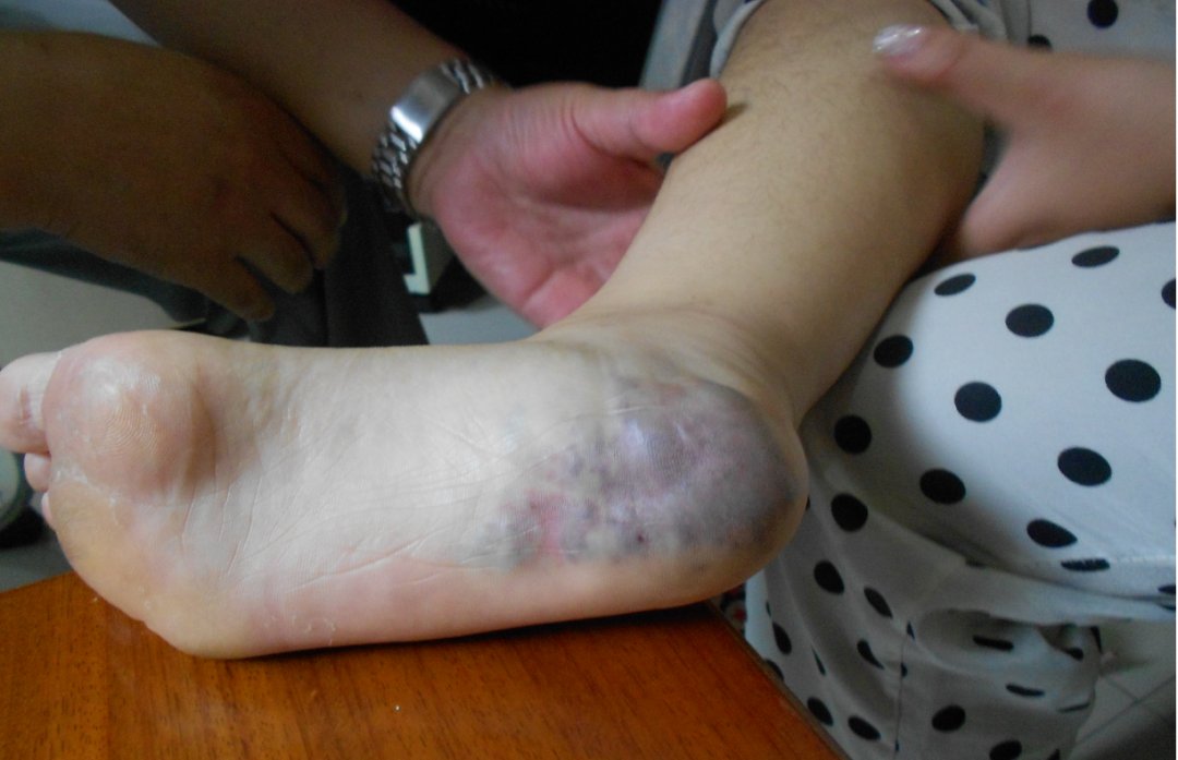 带你正确认识静脉畸形,做好防治!