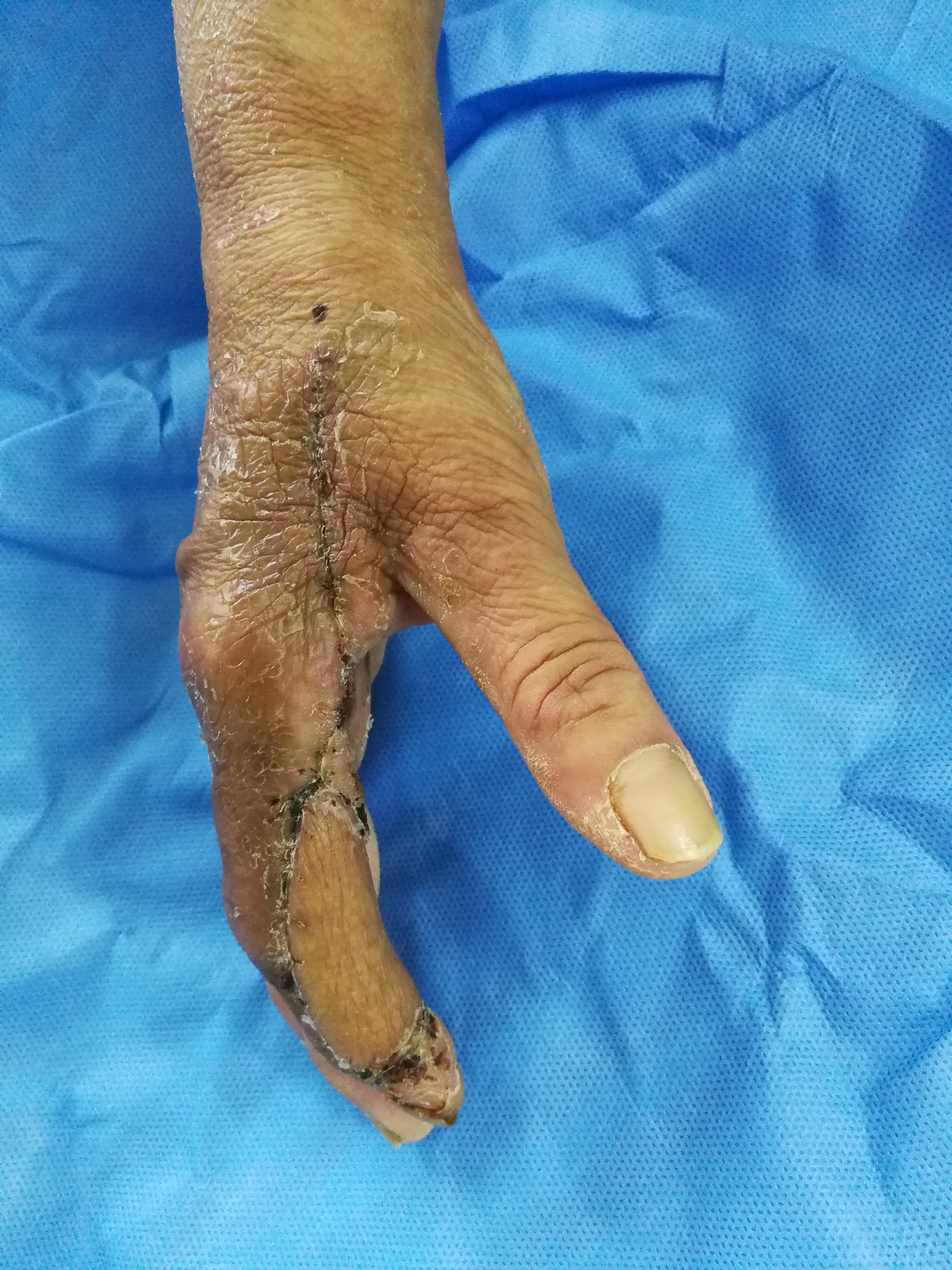 骨间背动脉穿支皮瓣修复手指皮肤软组织缺损的治疗. - 好大夫在线