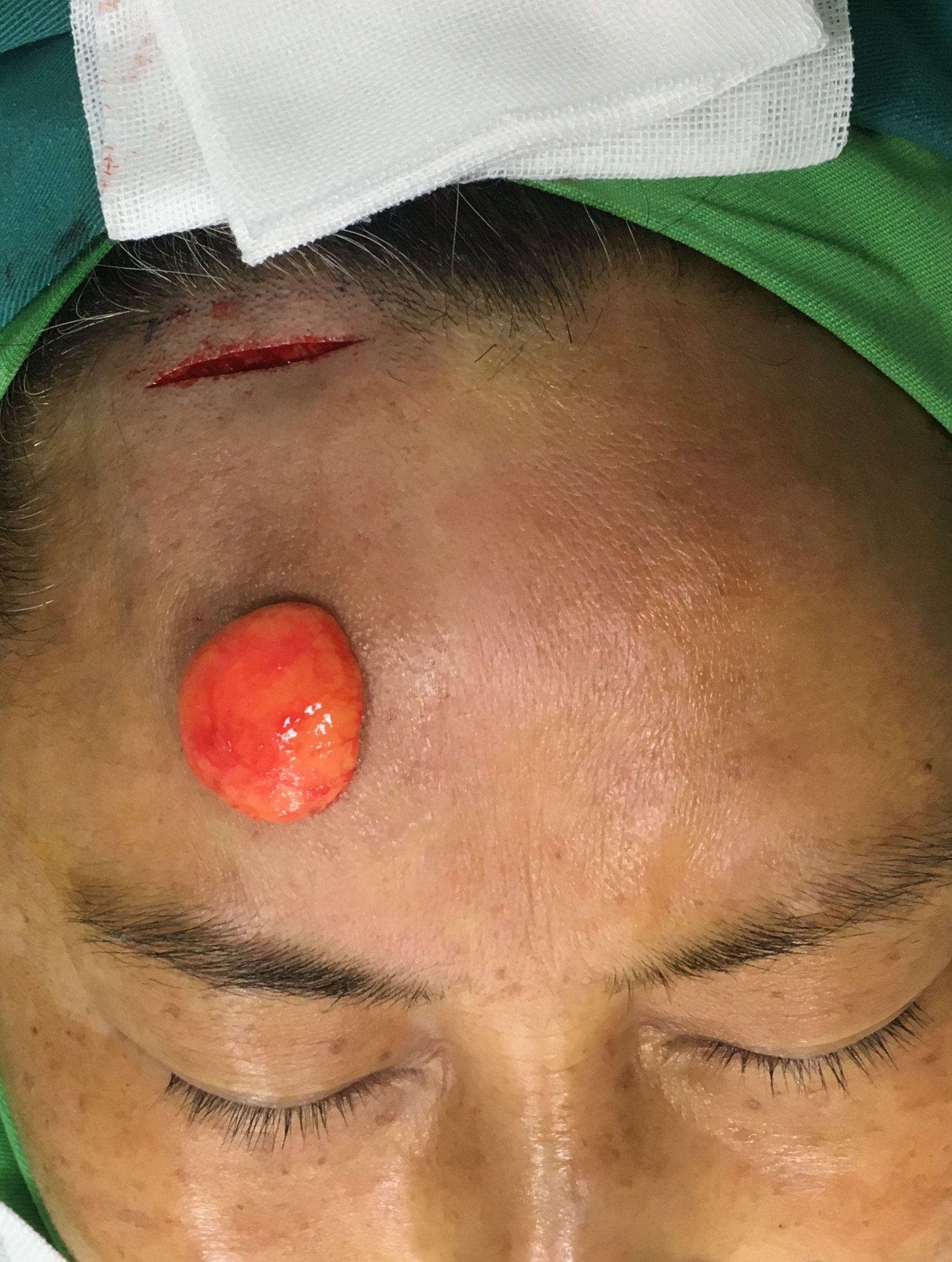 头部脂肪瘤图片 手术图片
