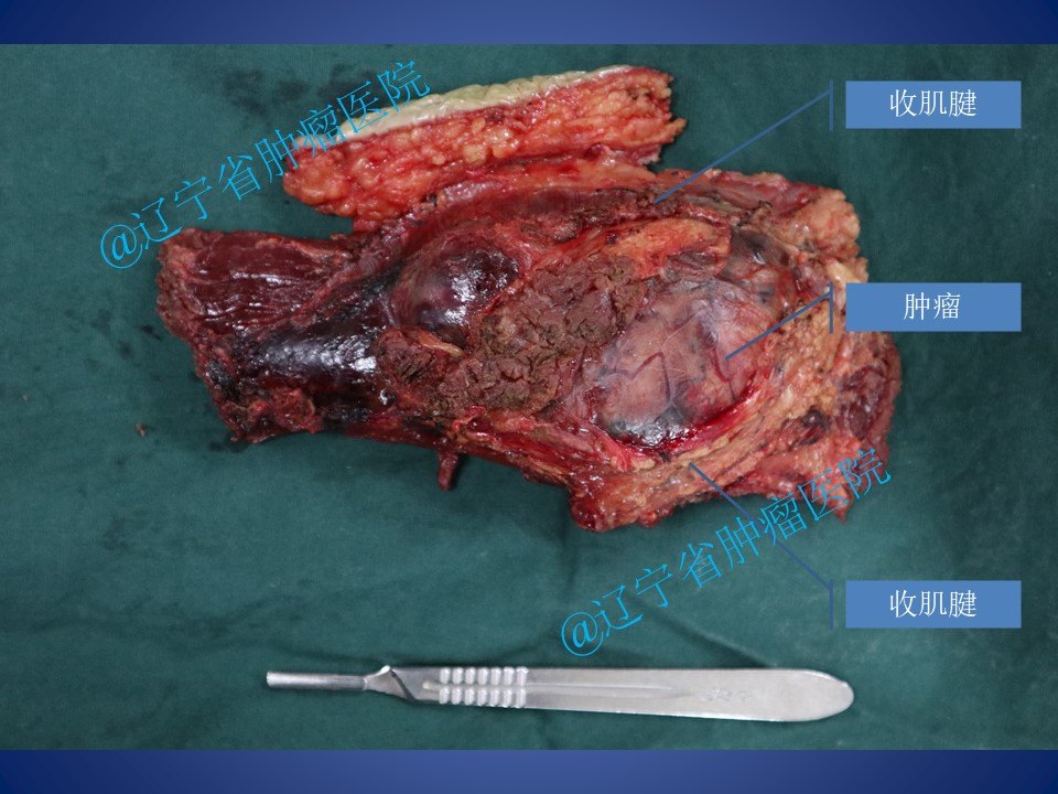 股部收肌管軟組織肉瘤手術病例分享 - 好大夫在線