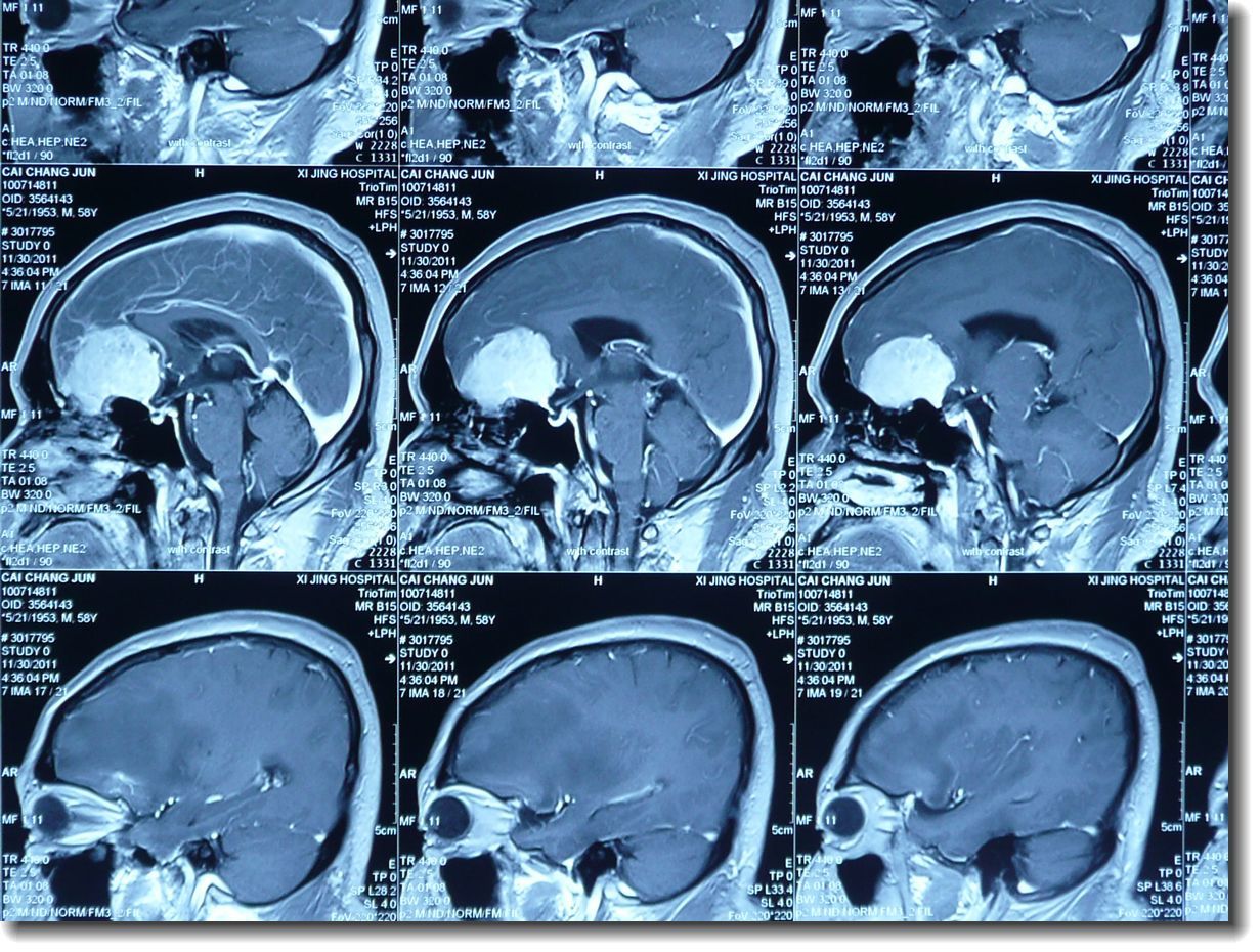 艰辛的历程:一位鞍结节脑膜瘤患者的治疗 - 好大夫在线