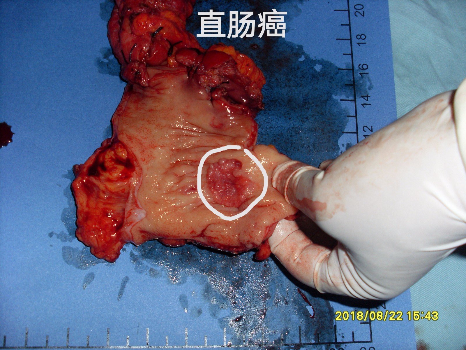 直肠腺癌早中晚期图片图片