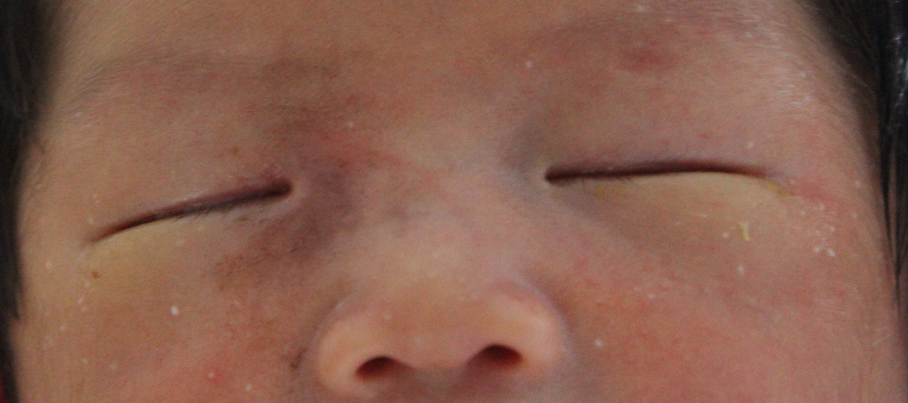 新生宝宝泪囊炎图片图片