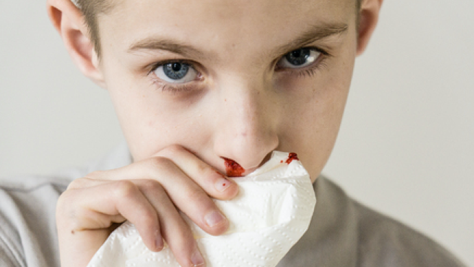 经常流鼻血是白血病吗？