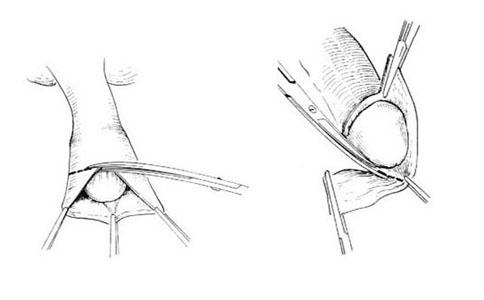 袖套式包皮环切术(双切口包皮环切术)优点:损伤小,出血少,术后水肿轻