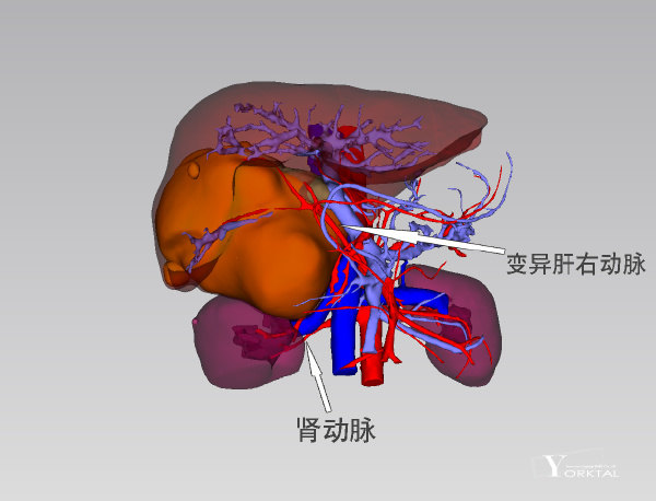 13动脉血管的变异以孙延富教授为首的专家团队根据术前对该患者精细