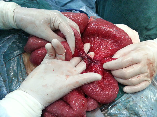 结核性腹膜炎腹部照片图片