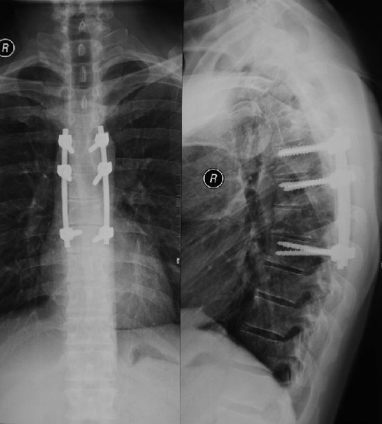 术后x线片示胸椎6,7椎间隙后部相邻终板和椎体切除术后矢状位ct示胸6