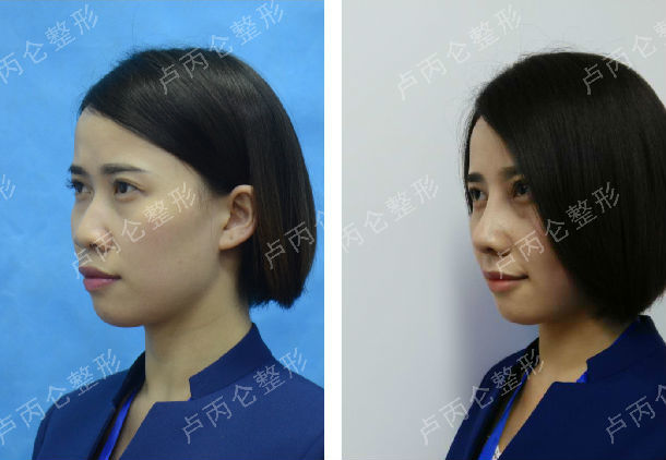 硅胶假体隆鼻术+耳软骨鼻尖整形术+鼻骨截骨