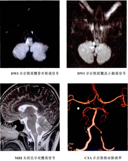 延髓核磁图片