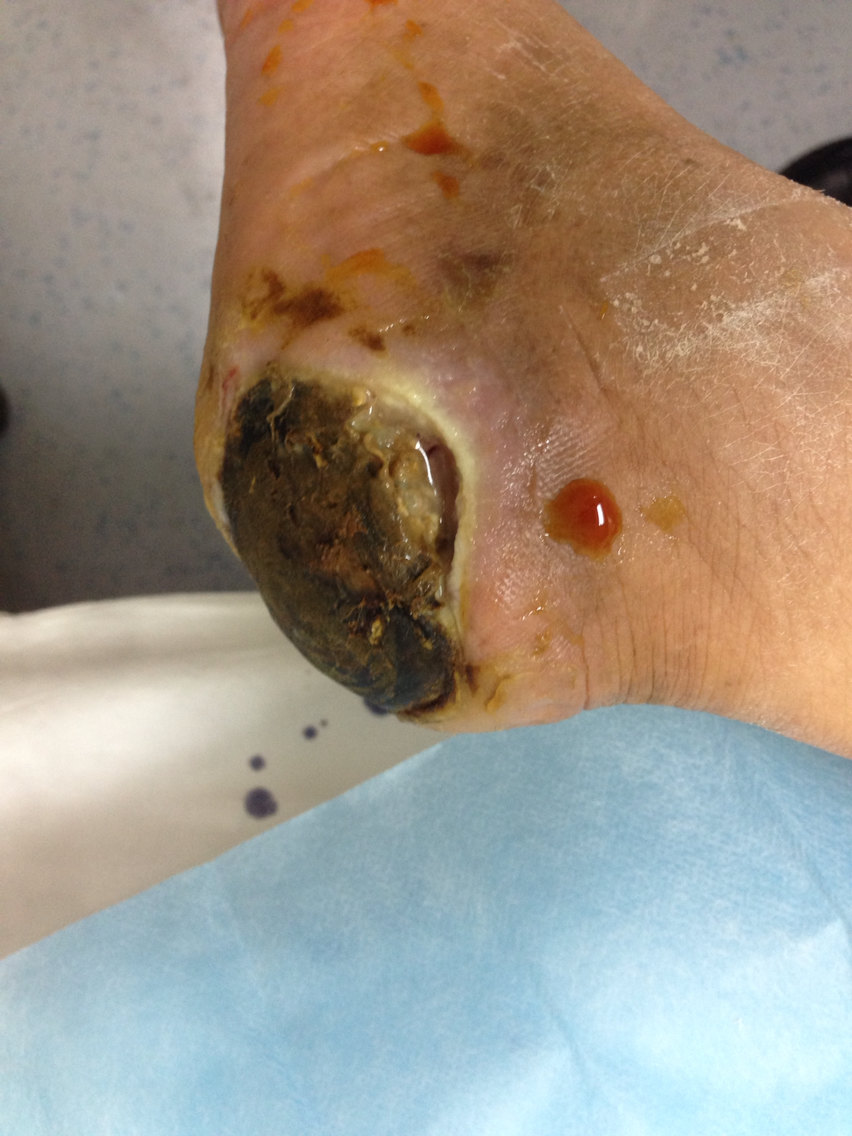 糖尿病足的诊治_糖尿病足_症状_症状表现 - 好大夫在线