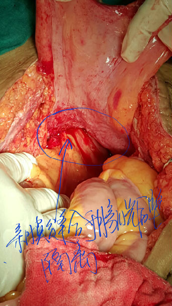 卵巢癌大网膜切除图解图片