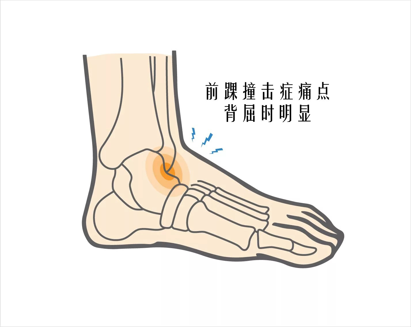 球踢多了脚踝痛 有可能是前踝撞击症 踝部扭伤 踝部扭伤