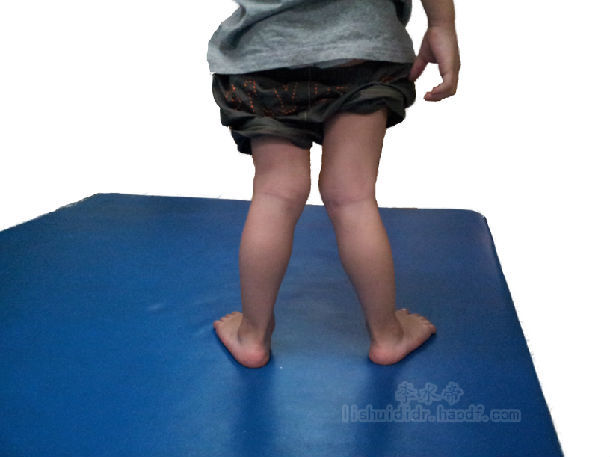 膝外翻又称碰腿症,俗称外八字腿,以两下肢自然伸直或站立时,两膝能
