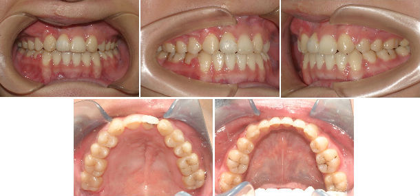 唇腭裂的正畸治疗
