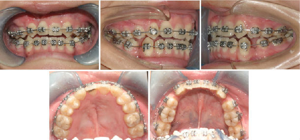以下是我完成的一个病例,矫治(矫正)周期从2011.01.17-2015.05.