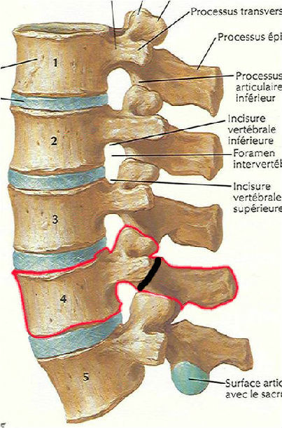 腰椎峡部裂图图片