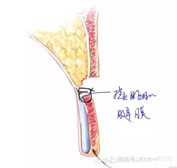 醫生我為什麼是單眼皮呢