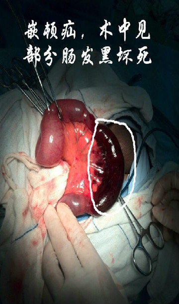 最严重的临床表现是嵌顿疝并肠绞窄:患者呈持续性剧烈腹痛,呕吐频繁