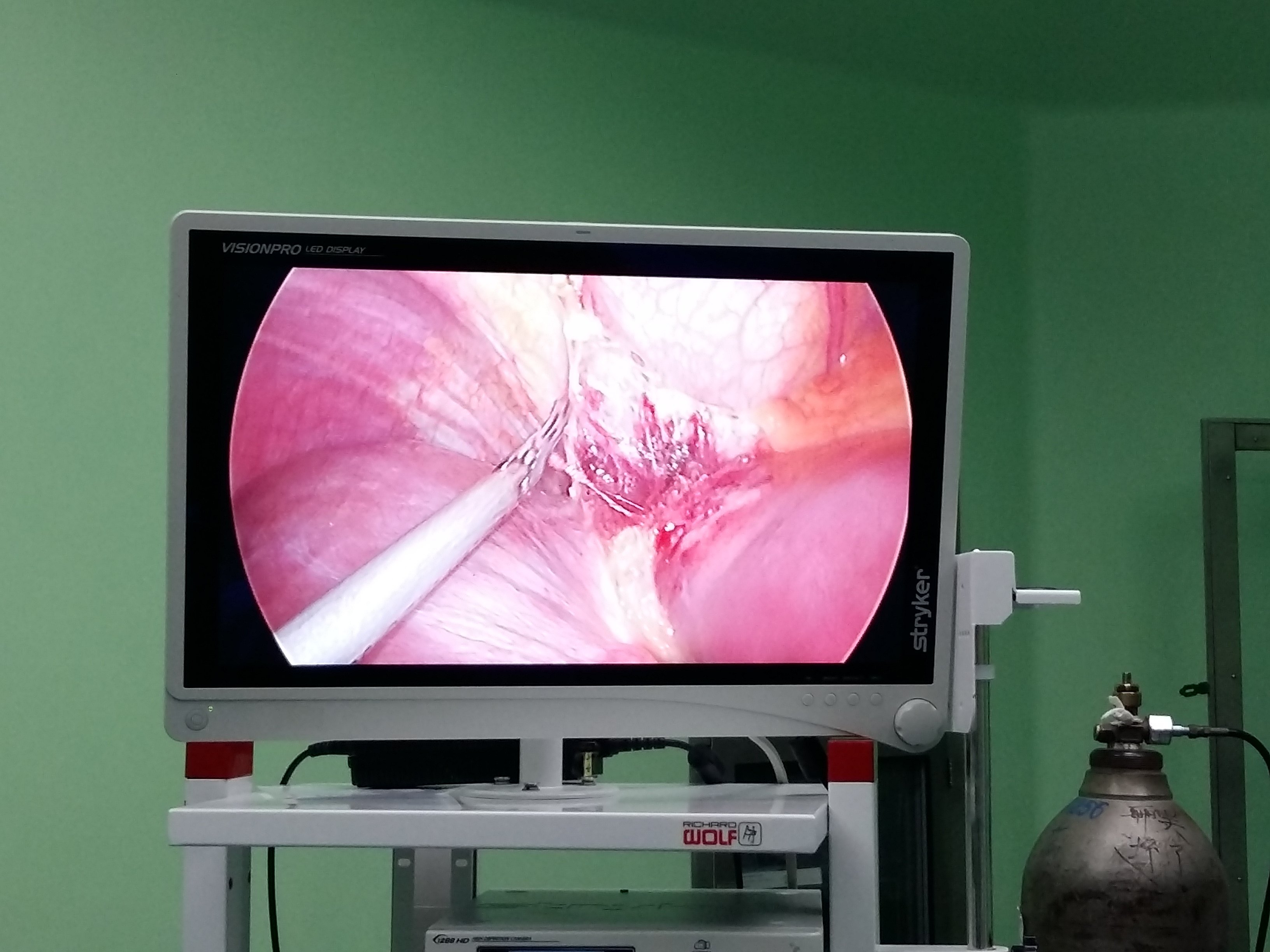 承医附院外一科腹腔镜左肝外叶切除术治疗肝癌成功开展 - 好大夫在线