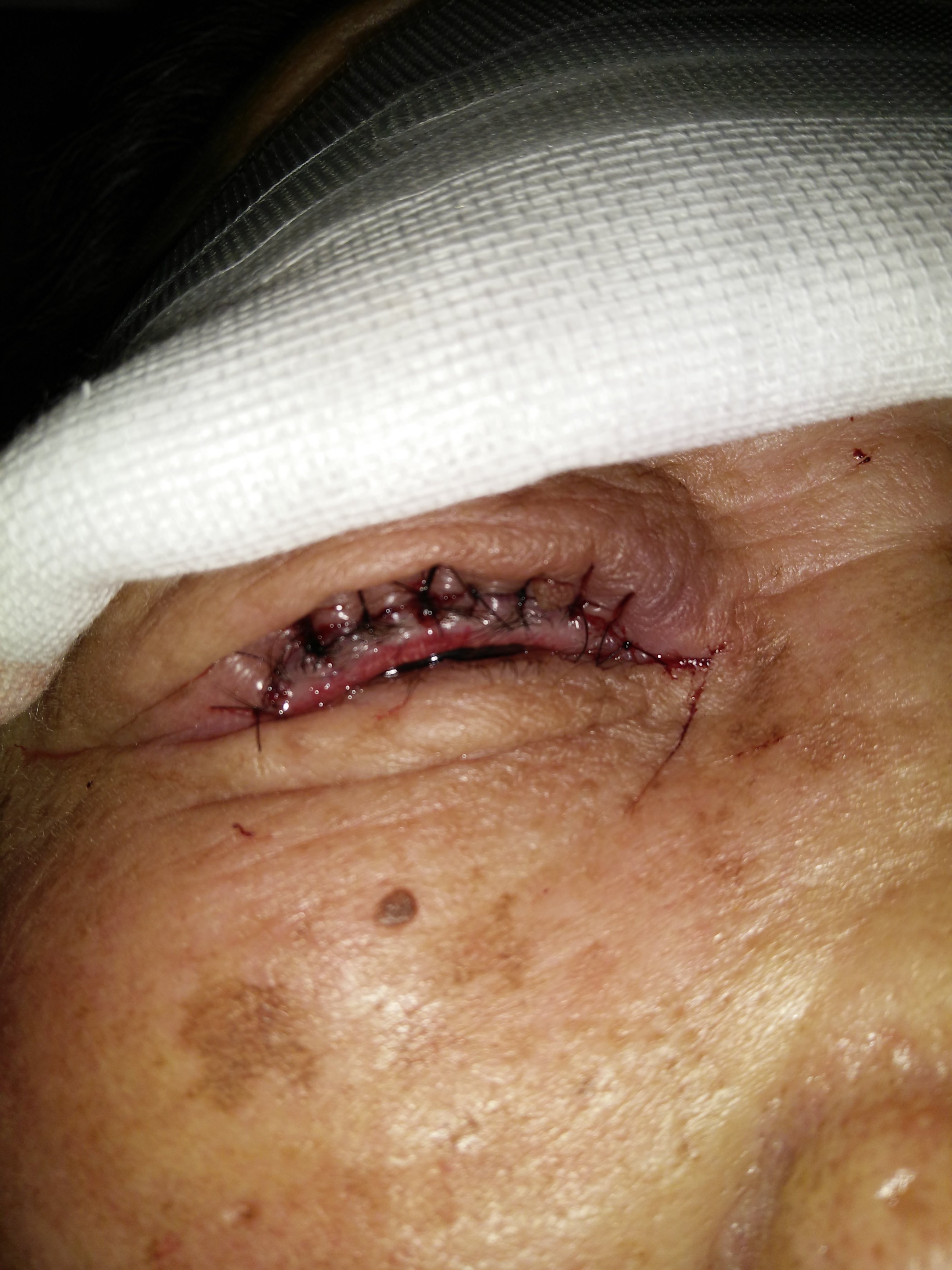 上睑倒睫矫正术后.