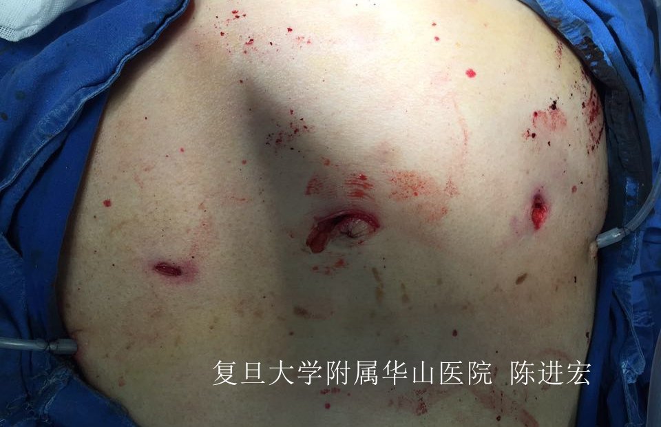 完全腹腔鏡下胰十二指腸切除術