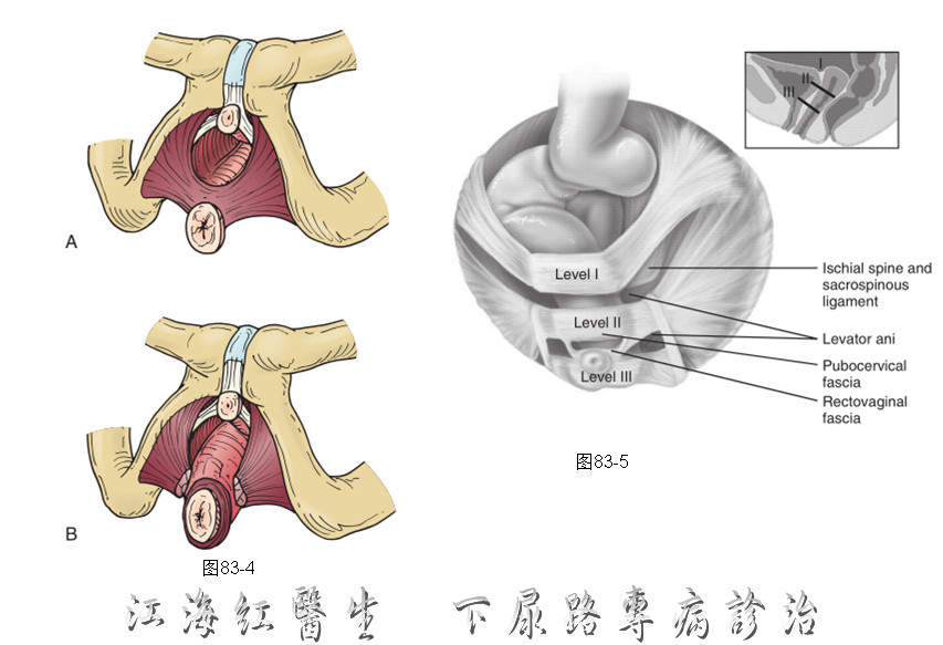 下尿路整合盆底 1 | 盆腔器官脫垂經陰和經腹重建手術介紹系列 - 好大