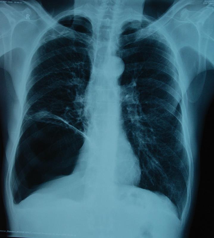 什么类型的肺气肿适合微创手术治疗