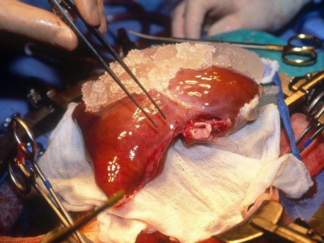 liver-transplant-procedure-667x500.jpg