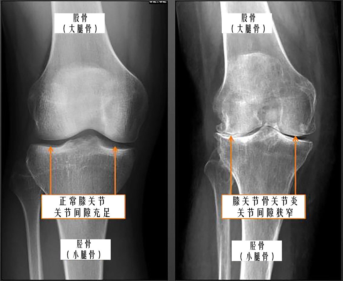 膝关节x线正常图片图片