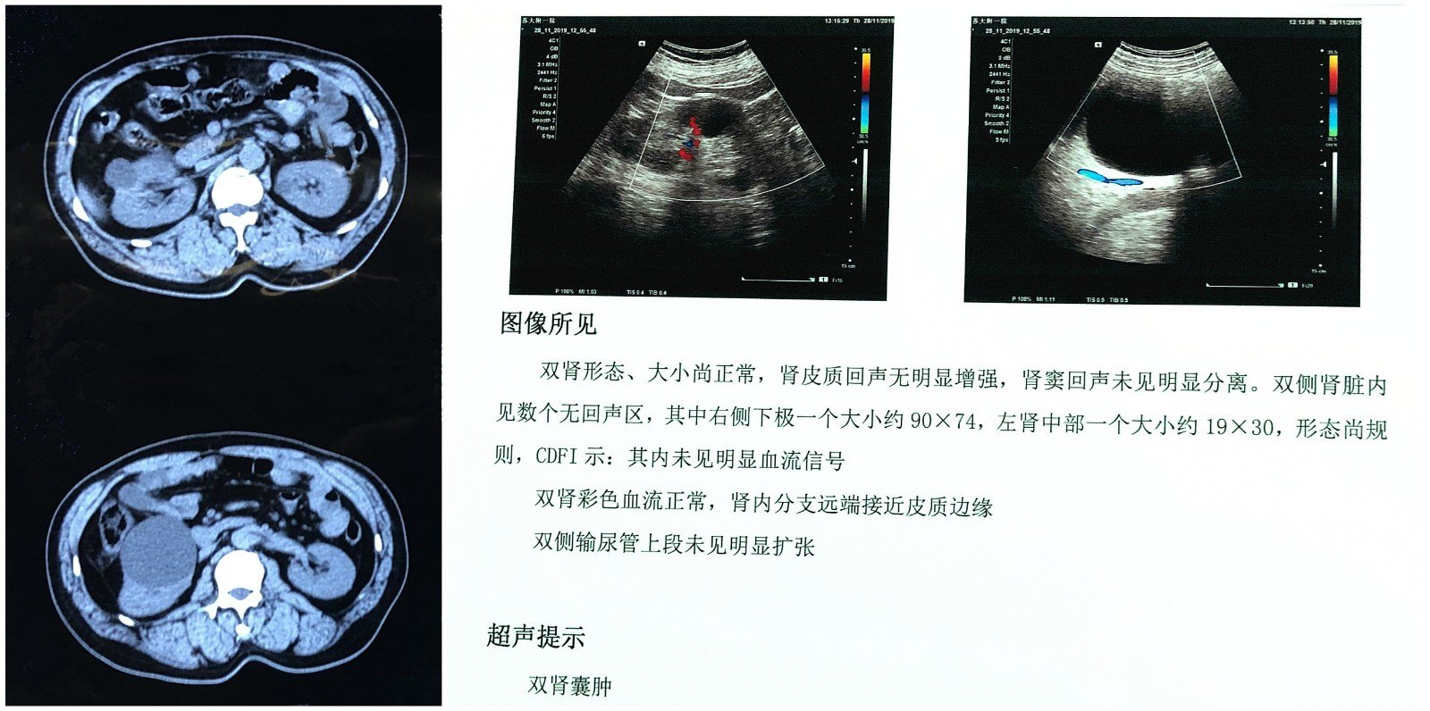 肾囊肿会复发和癌变吗_肾癌_预后_发病原因 - 好大夫在线