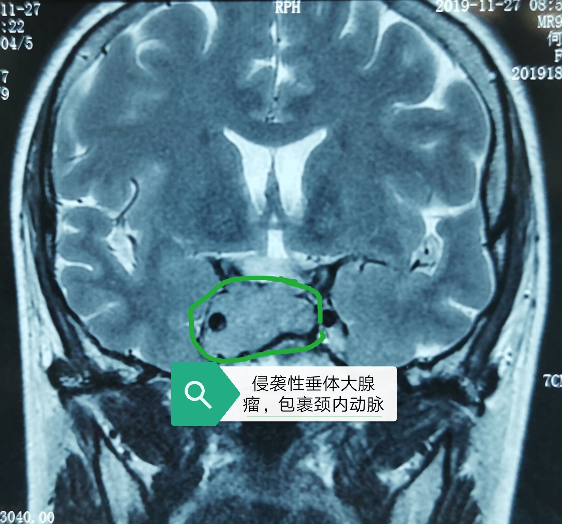 神经内镜下顺利切除二台侵袭性垂体大腺瘤 - 好大夫在线