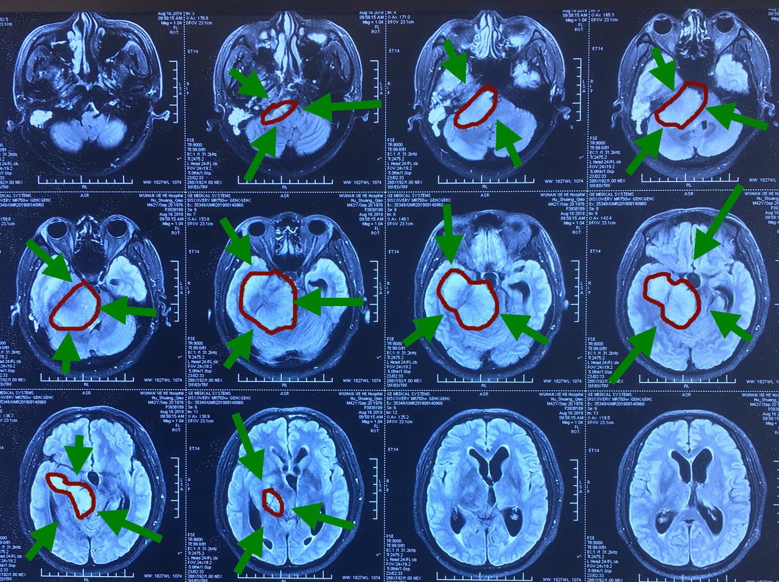天坛医院黄牛排队挂号CT加急说到必须做到的简单介绍 天坛医院黄牛排队挂号CT加急说到必须做到的简单介绍