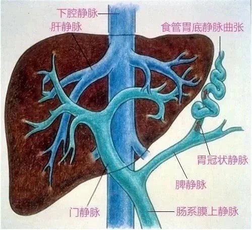 肝硬化小心胃出血大出血也可致命