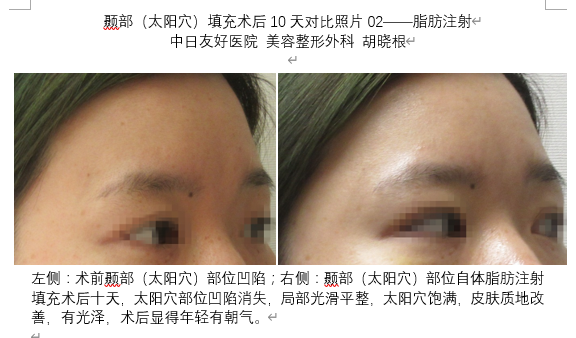 颞部 太阳穴 填充术后10天对比照片02 脂肪注射 脂肪填充 脂肪填充 颞部 太阳穴 填充术后10天对比照片02 脂肪注射 脂肪填充 脂肪填充