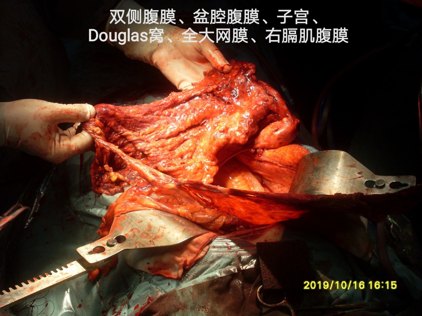 病例133--腹膜转移病理为浆液癌,是卵巢癌还是原发性腹膜癌?