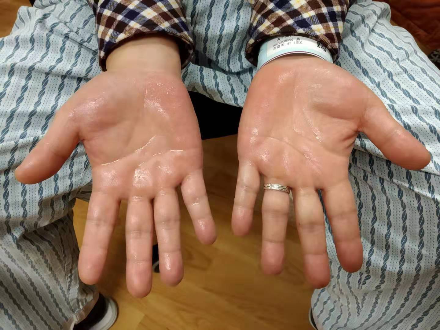 原发性手汗症胸腔镜微创手术切断双侧交感神经链,立干见影 - 好大夫