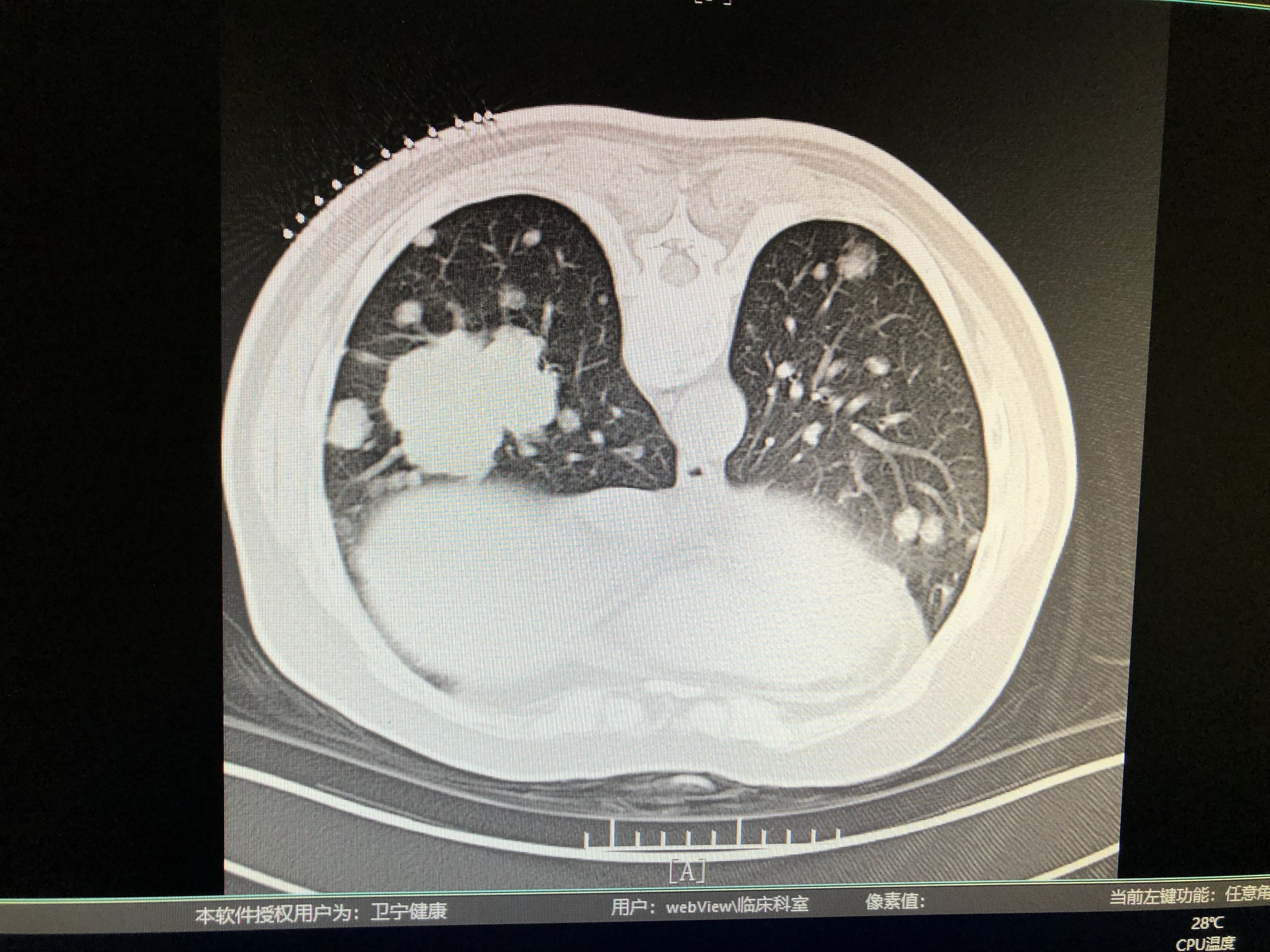 晚期肺癌ct图片图片