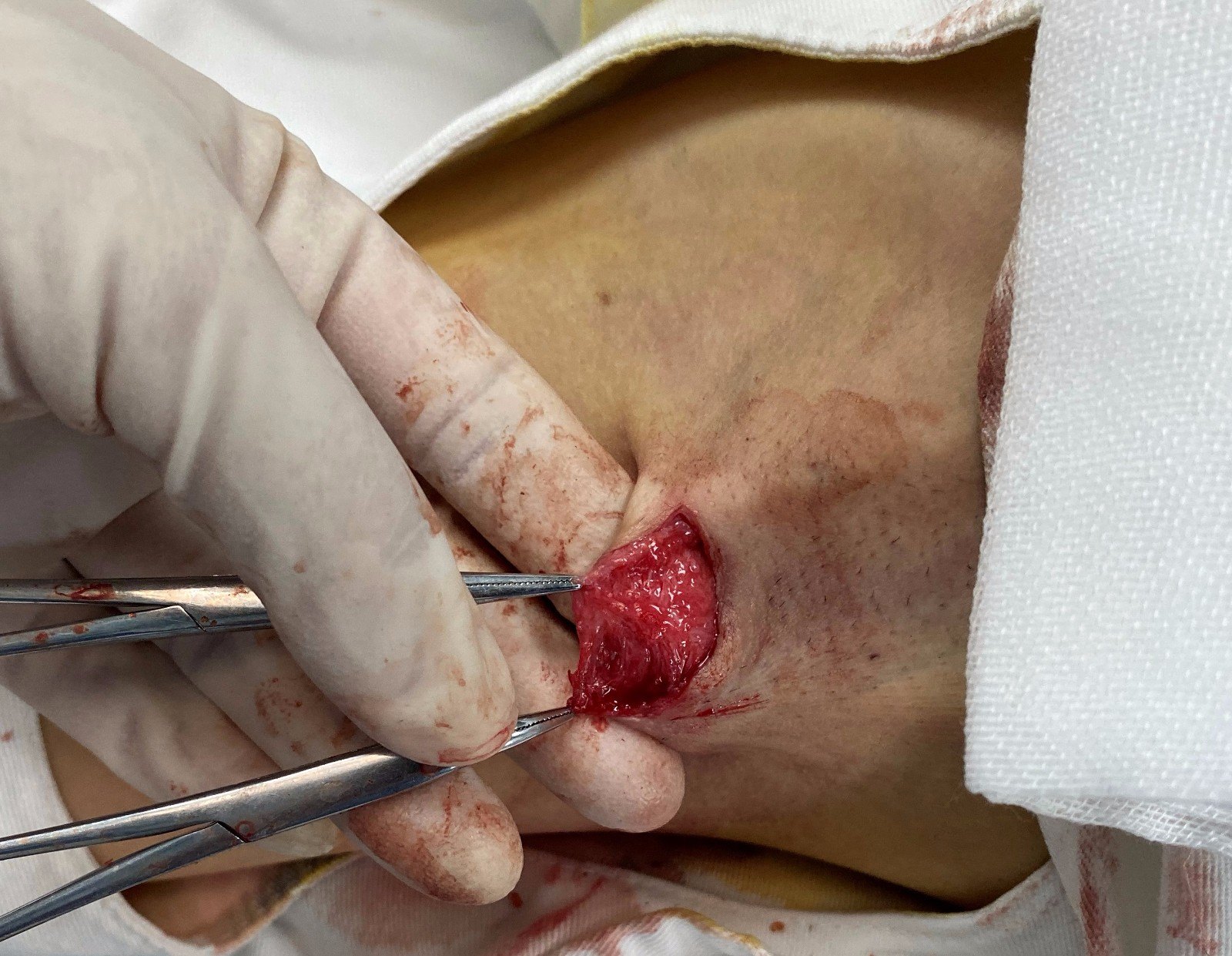 3cm长的刀口,分离皮下,翻转皮瓣采用直视下剪除大汗腺,此