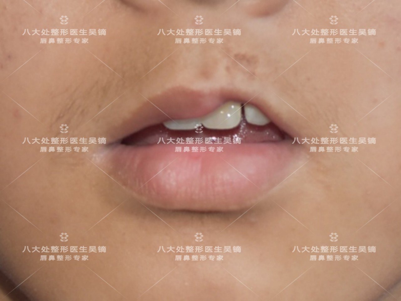 嘴唇血管畸形图片
