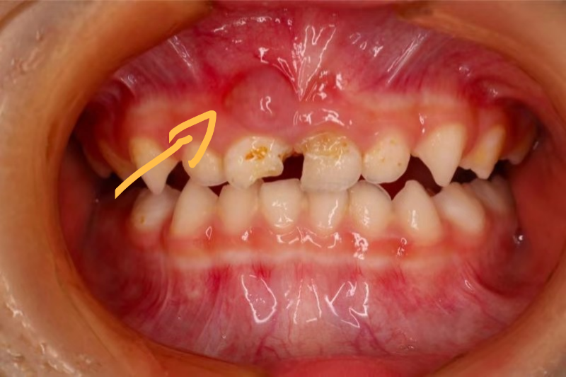 16个月宝宝牙龈肿图片图片