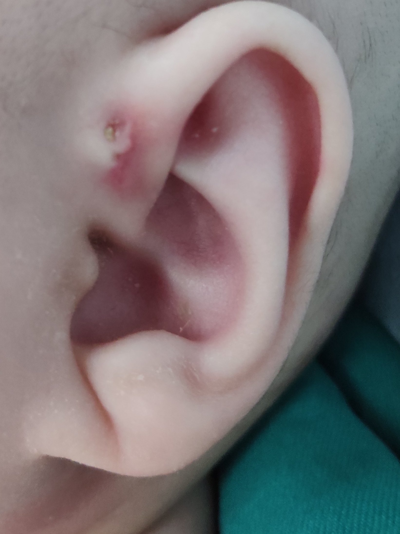 记鼠年第一台耳前瘘手术 
